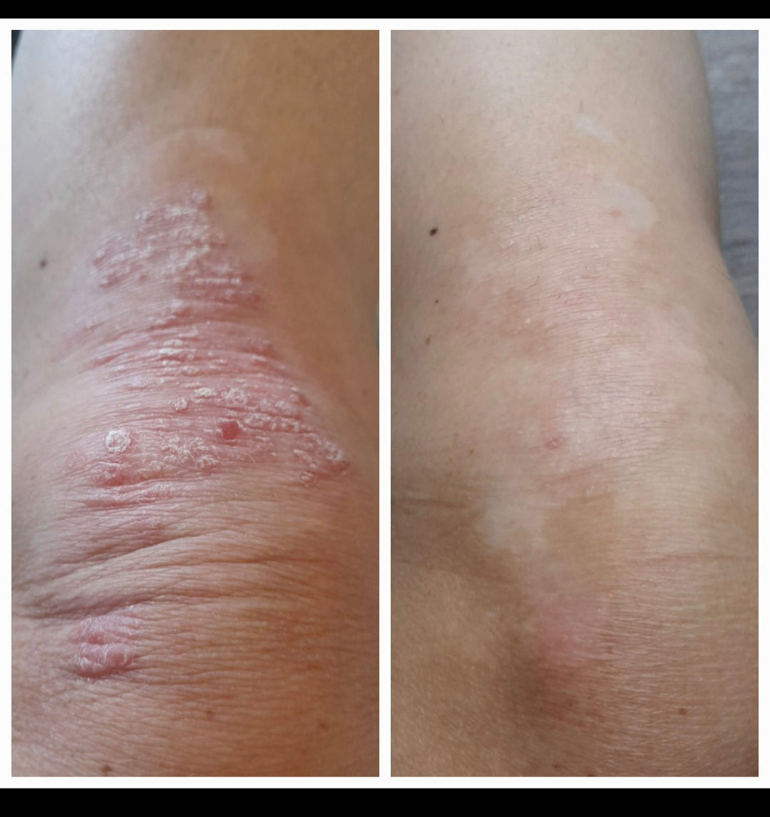 psoriasis knee before after skin