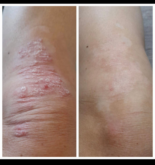 psoriasis knee before after skin